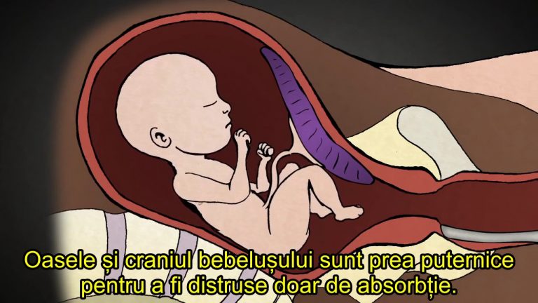 VIDEO Un medic a făcut 1.200 de avorturi. Acum dorește să arate lumii ce este, de fapt, un avort