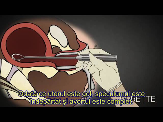 VIDEO Avortul în trimestrul I de sarcină: avortul prin aspirare D&C